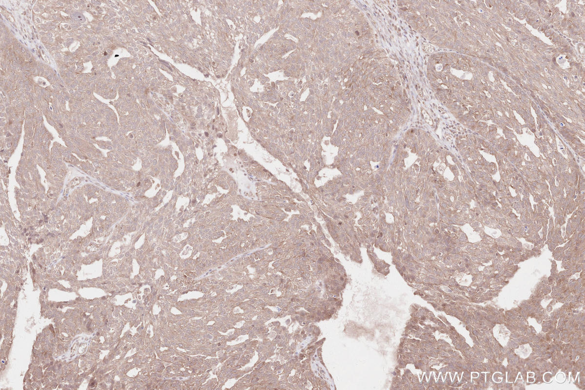 Immunohistochemical analysis of paraffin-embedded human ovary cancer tissue slide using KHC2558 (MLK4 IHC Kit).