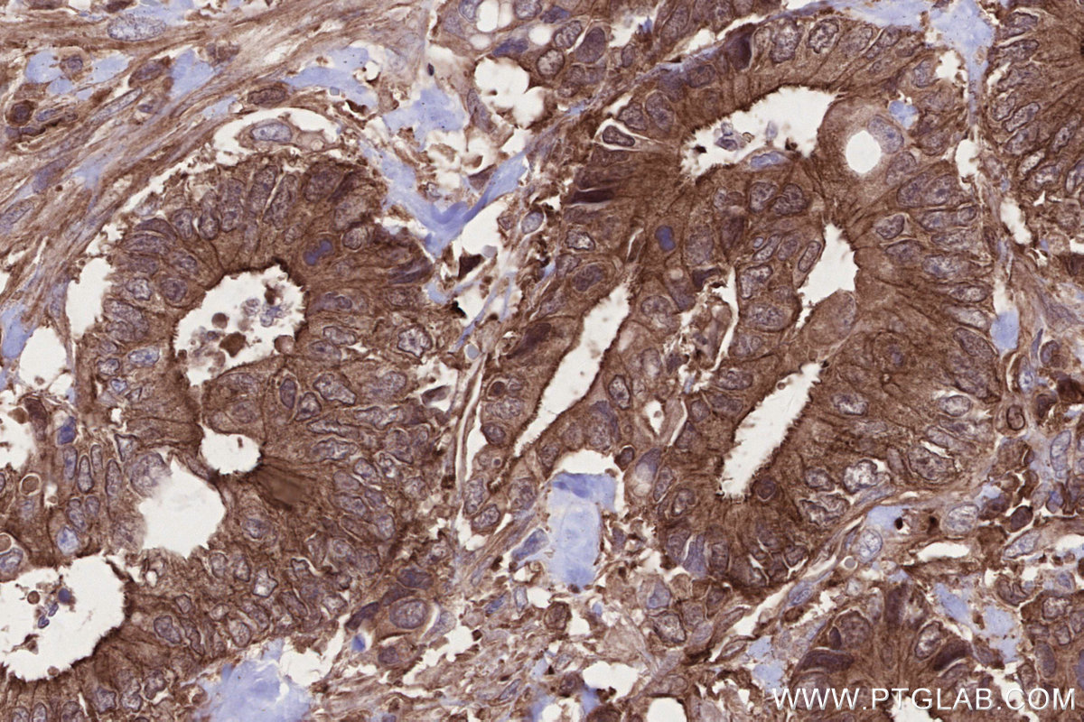 Immunohistochemical analysis of paraffin-embedded human rectal cancer tissue slide using KHC2686 (MLKL IHC Kit).