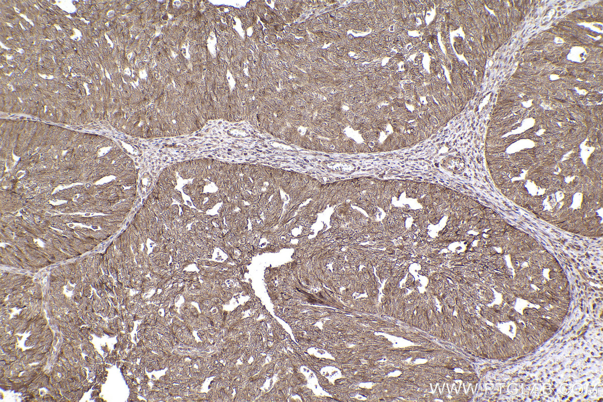 Immunohistochemical analysis of paraffin-embedded human ovary cancer tissue slide using KHC2430 (MTX1 IHC Kit).