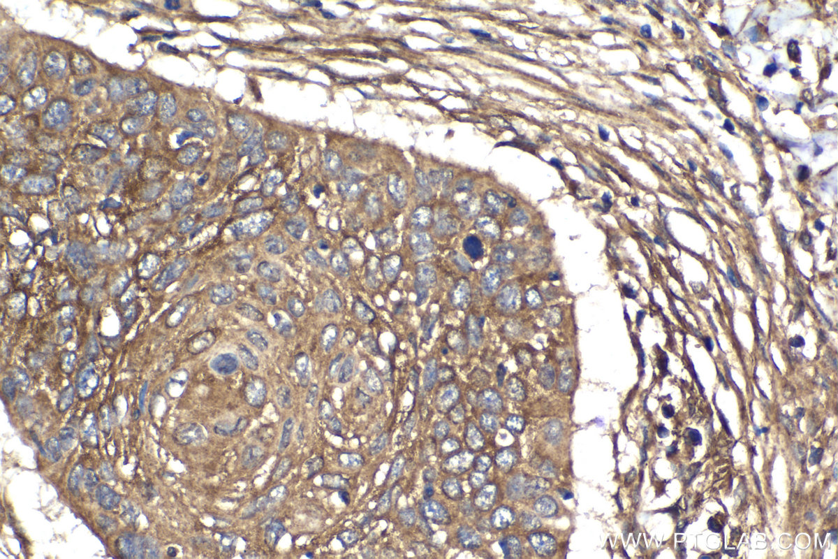 Immunohistochemical analysis of paraffin-embedded human oesophagus cancer tissue slide using KHC2116 (MYCBP2 IHC Kit).