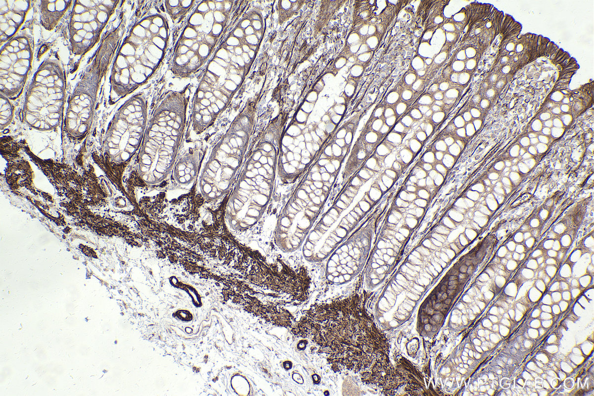 Immunohistochemical analysis of paraffin-embedded human rectal cancer tissue slide using KHC2496 (MYLK IHC Kit).