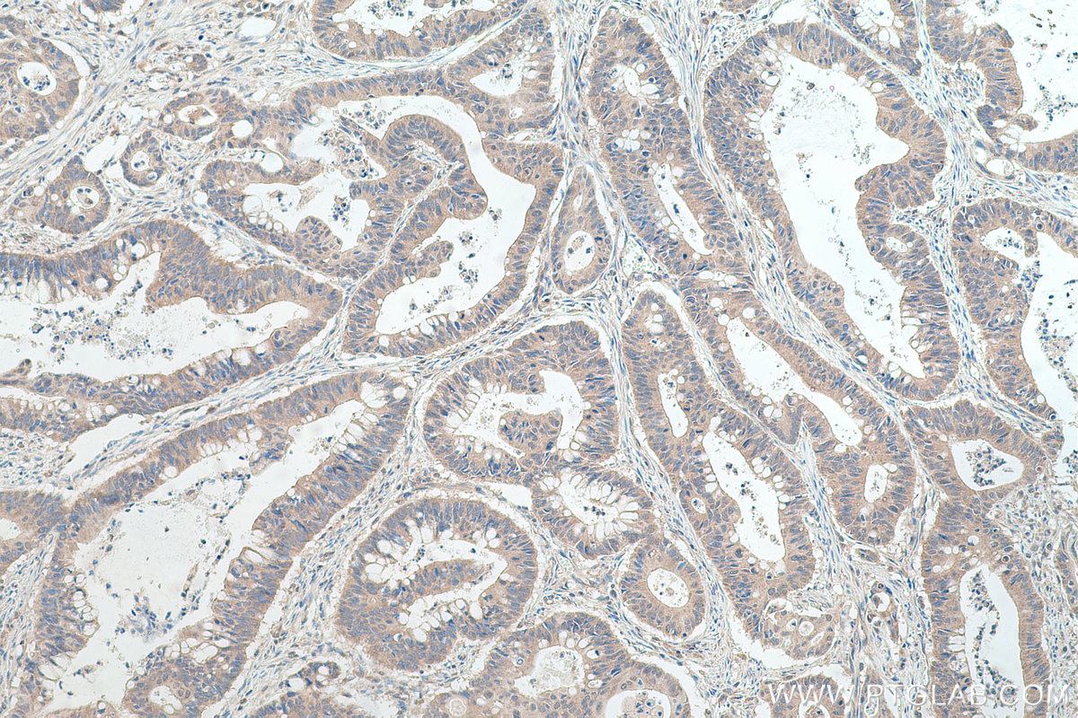 Immunohistochemical analysis of paraffin-embedded human colon cancer tissue slide using KHC0367 (MYO1B IHC Kit).