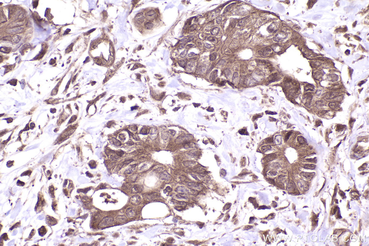 Immunohistochemical analysis of paraffin-embedded human rectal cancer tissue slide using KHC2478 (NCAPD2 IHC Kit).