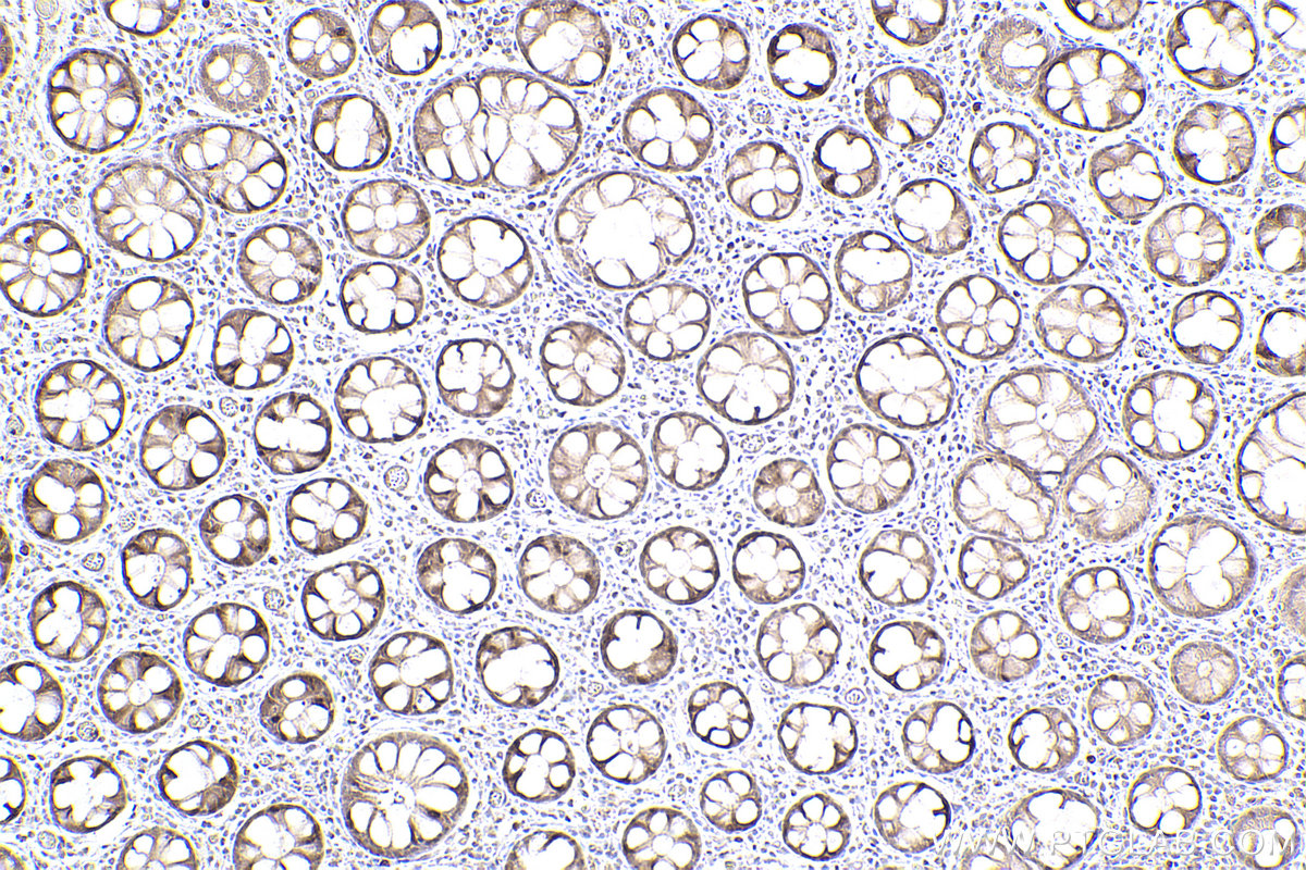 Immunohistochemical analysis of paraffin-embedded human rectal cancer tissue slide using KHC2474 (NCAPH IHC Kit).