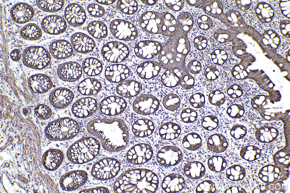 Immunohistochemical analysis of paraffin-embedded human rectal cancer tissue slide using KHC2507 (NDUFA5 IHC Kit).