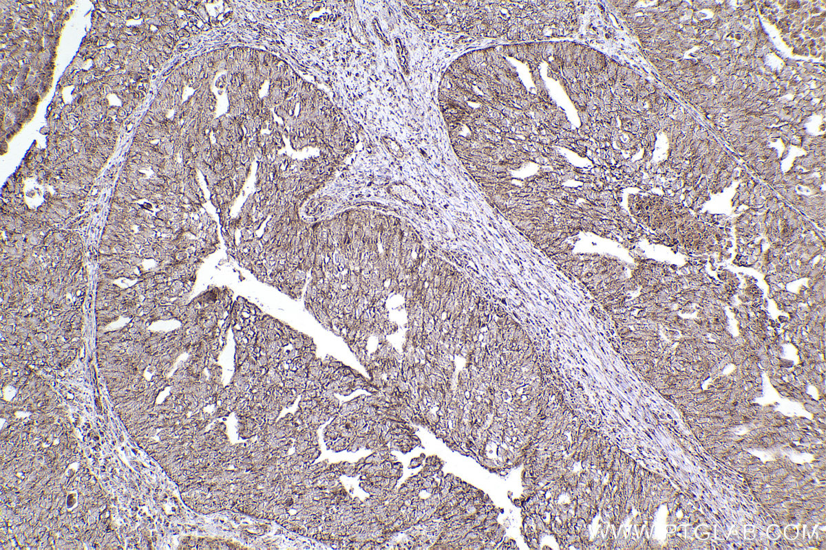 Immunohistochemical analysis of paraffin-embedded human ovary cancer tissue slide using KHC2507 (NDUFA5 IHC Kit).