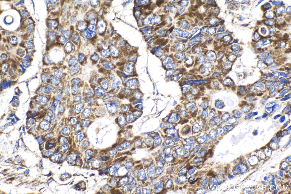 Immunohistochemical analysis of paraffin-embedded human stomach cancer tissue slide using KHC2114 (NDUFS3 IHC Kit).