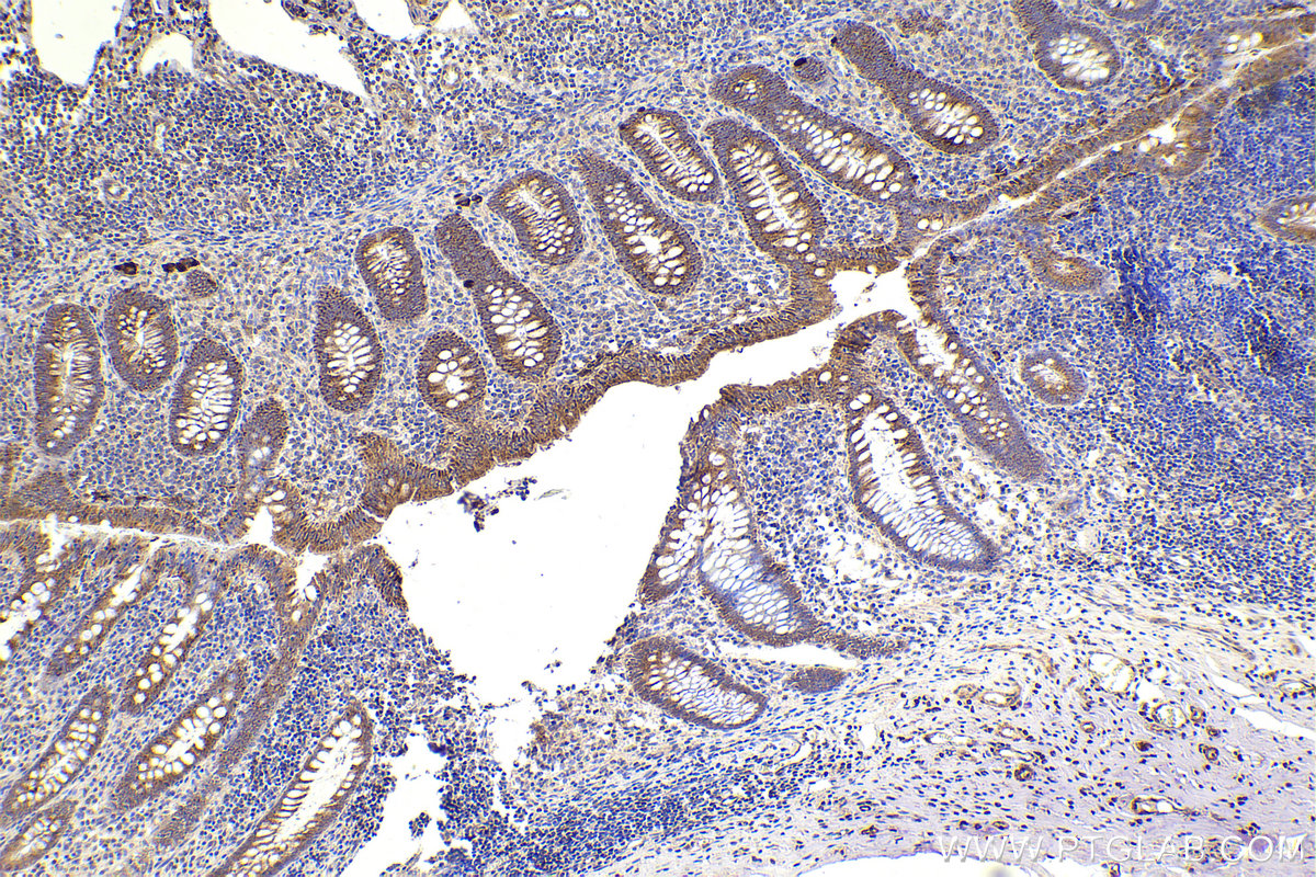 Immunohistochemical analysis of paraffin-embedded human appendicitis tissue slide using KHC2307 (NEK2 IHC Kit).