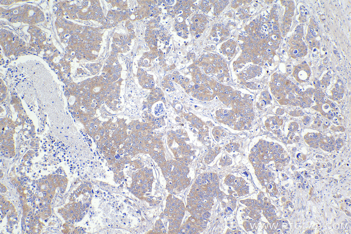 Immunohistochemical analysis of paraffin-embedded human stomach cancer tissue slide using KHC2206 (OSBP IHC Kit).