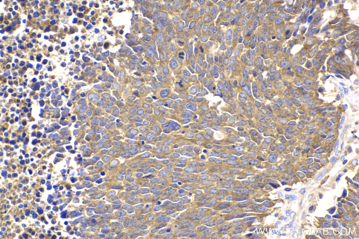 Immunohistochemical analysis of paraffin-embedded human lung cancer tissue slide using KHC2207 (PAICS IHC Kit).