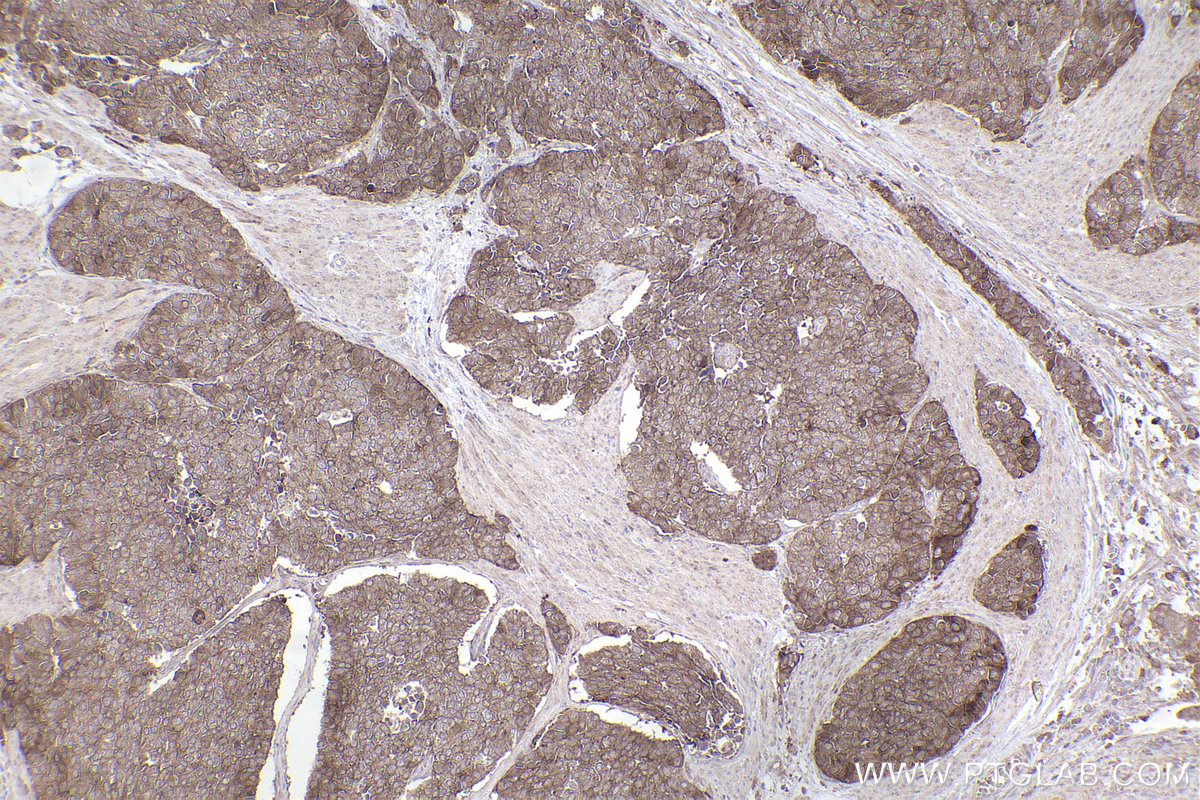 Immunohistochemical analysis of paraffin-embedded human stomach cancer tissue slide using KHC2458 (PAK1 IHC Kit).