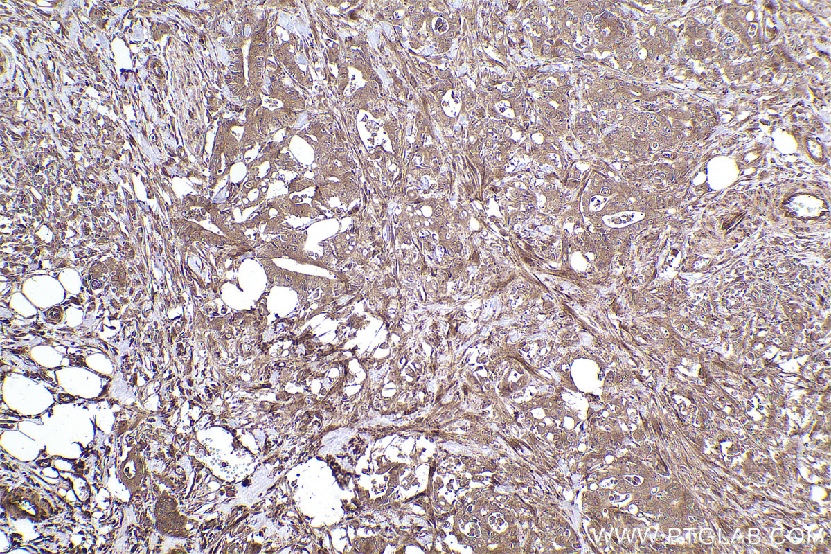 Immunohistochemical analysis of paraffin-embedded human rectal cancer tissue slide using KHC2540 (PAN3 IHC Kit).