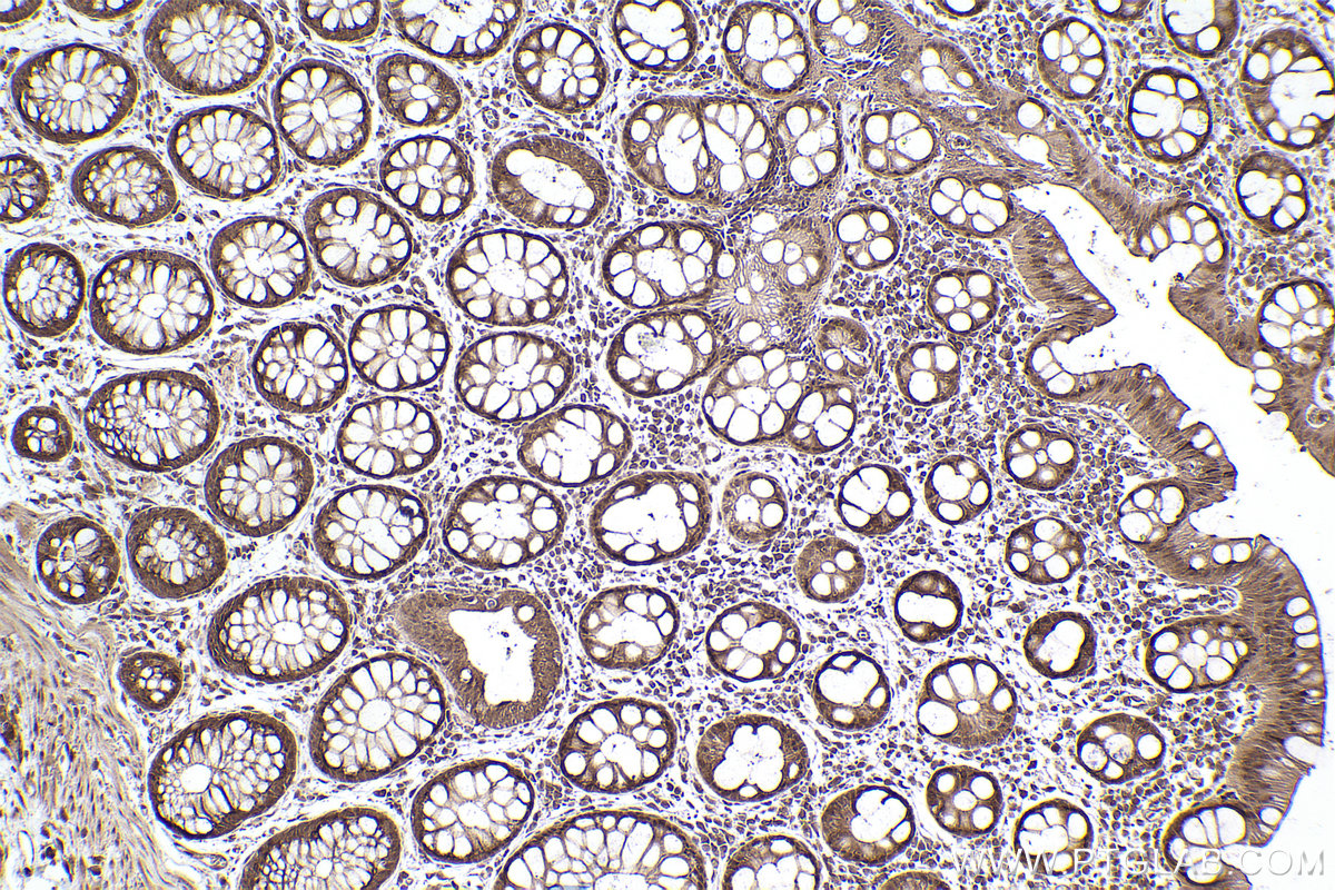 Immunohistochemical analysis of paraffin-embedded human rectal cancer tissue slide using KHC2486 (PCBP2 IHC Kit).