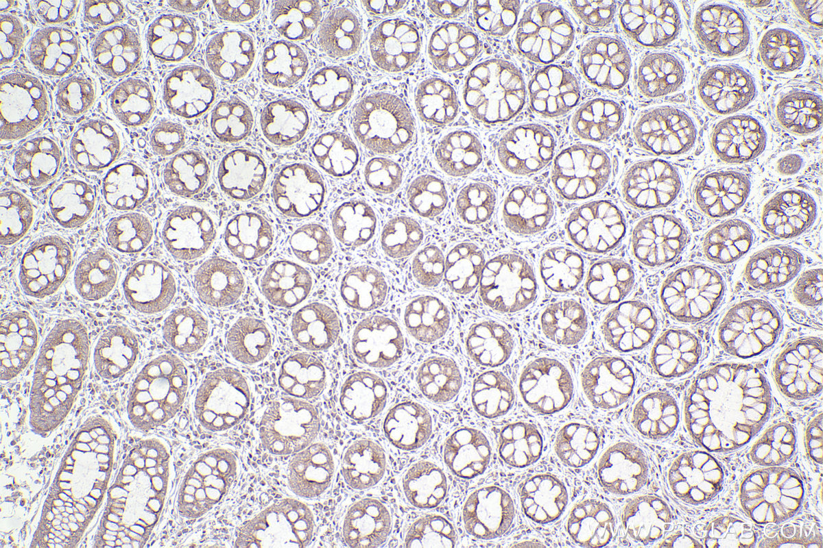 Immunohistochemical analysis of paraffin-embedded human rectal cancer tissue slide using KHC2518 (PCM1 IHC Kit).