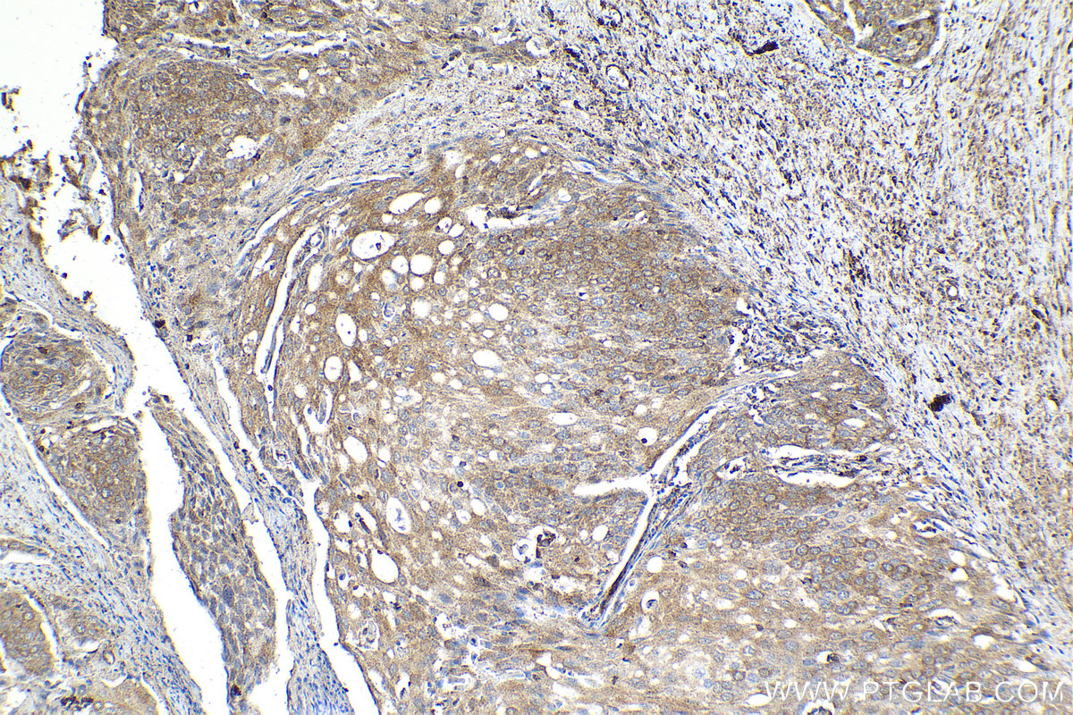 Immunohistochemical analysis of paraffin-embedded human cervical cancer tissue slide using KHC2126 (PDE5A IHC Kit).