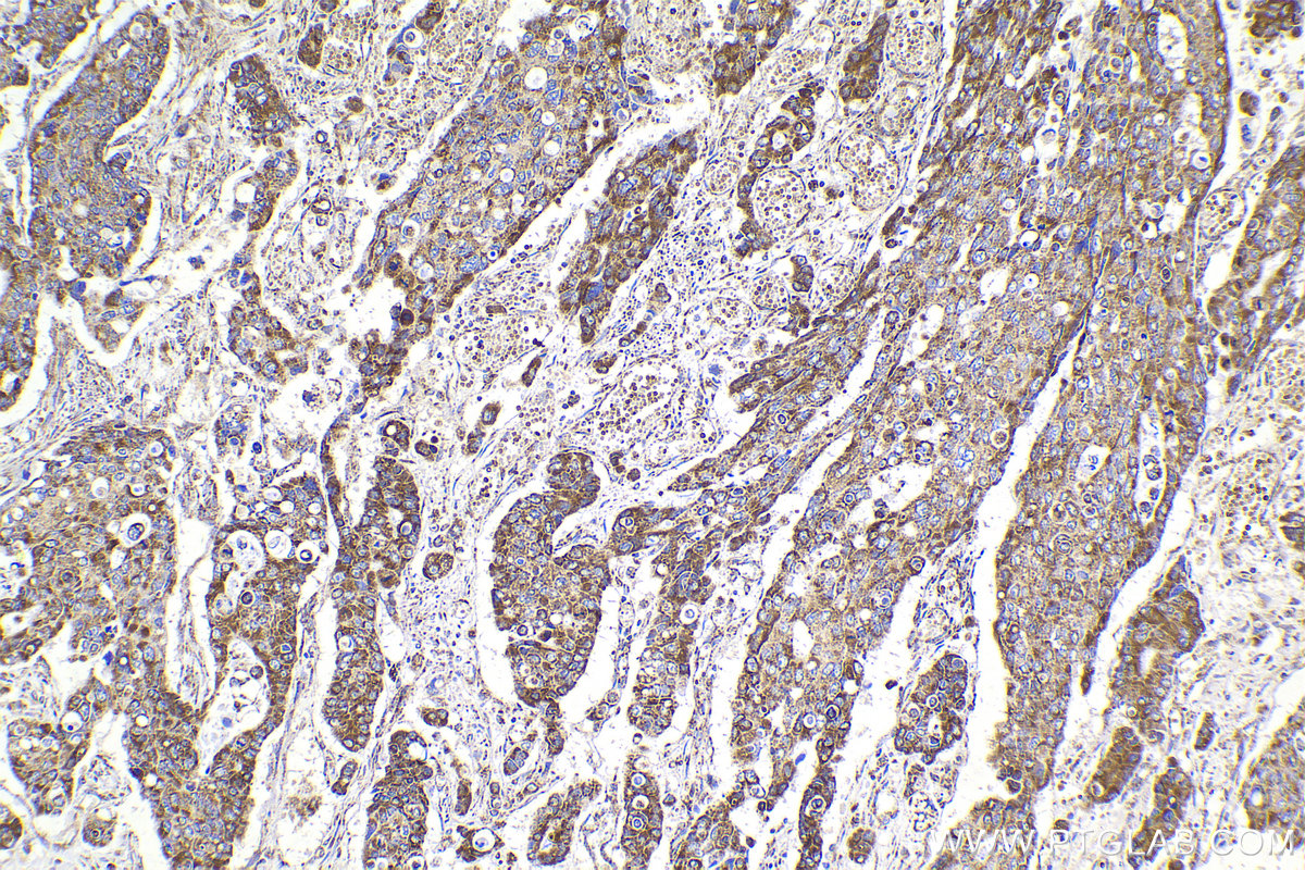 Immunohistochemical analysis of paraffin-embedded human stomach cancer tissue slide using KHC2169 (PDHA1 IHC Kit).