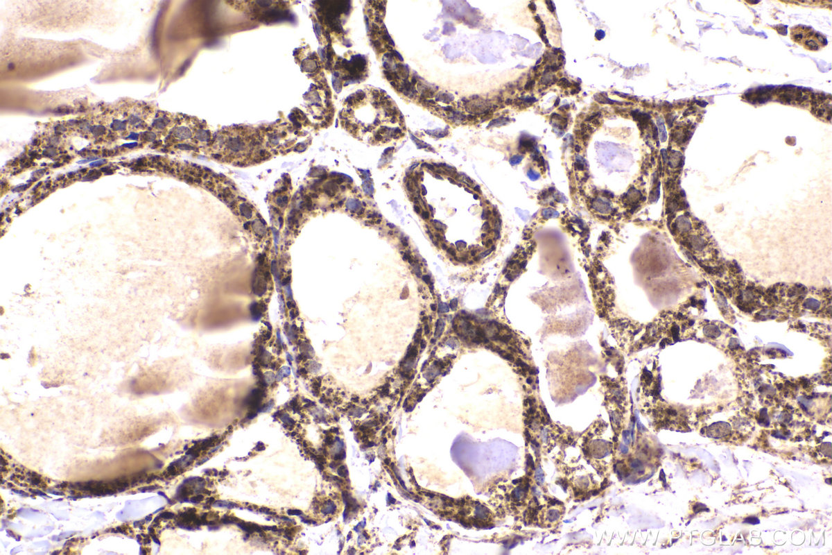 Immunohistochemical analysis of paraffin-embedded human thyroid cancer tissue slide using KHC2223 (PDHA2 IHC Kit).