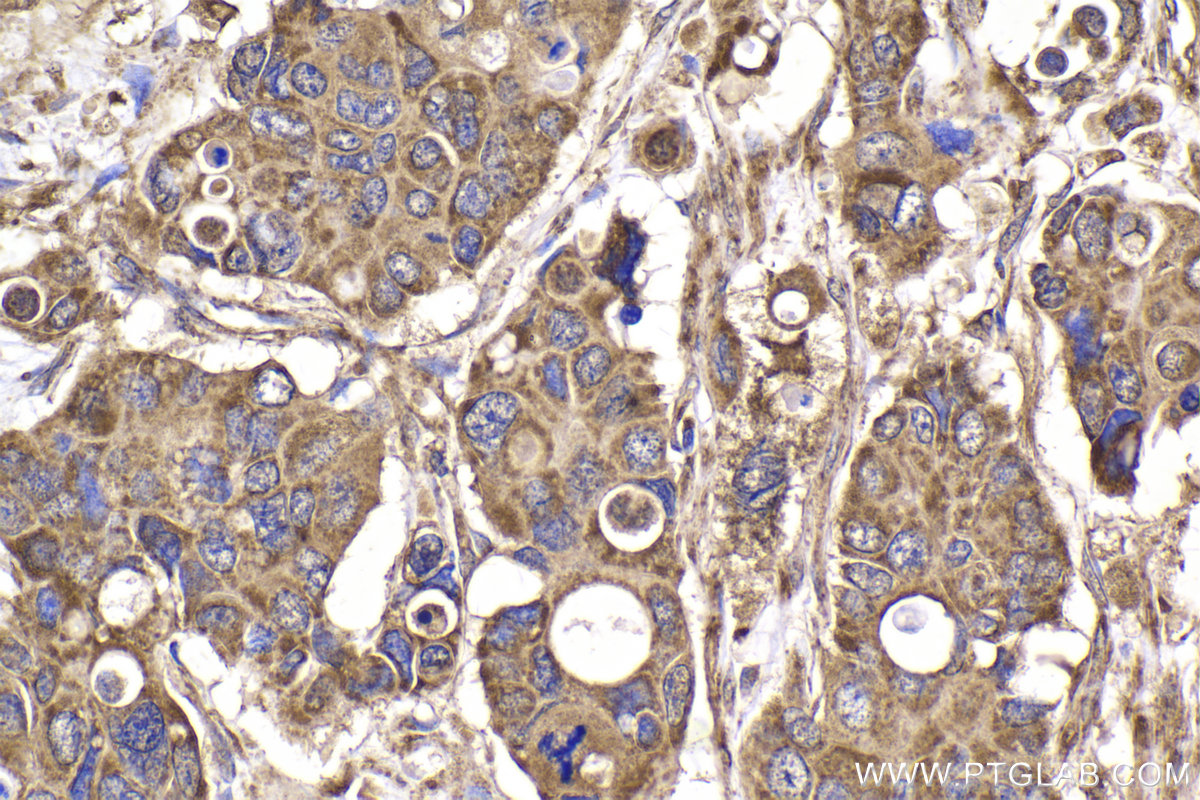 Immunohistochemical analysis of paraffin-embedded human stomach cancer tissue slide using KHC2178 (PDHB IHC Kit).