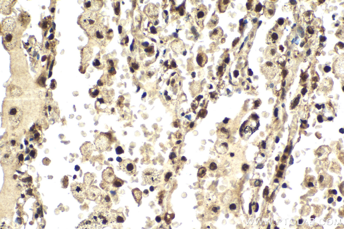 Immunohistochemical analysis of paraffin-embedded human lung cancer tissue slide using KHC2049 (PES1 IHC Kit).