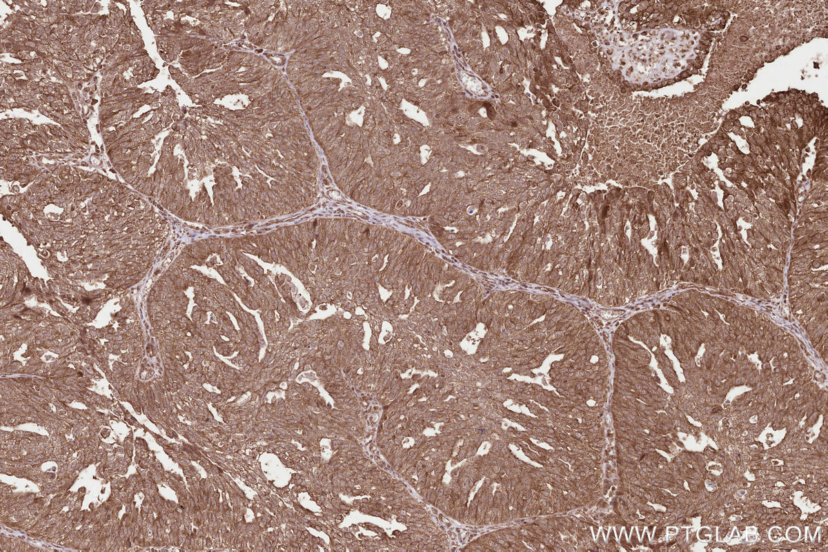 Immunohistochemical analysis of paraffin-embedded human ovary cancer tissue slide using KHC2579 (PHF17 IHC Kit).