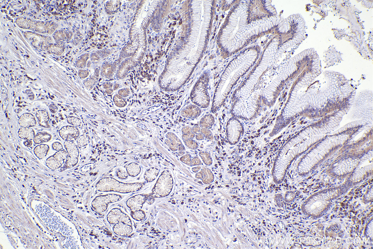 Immunohistochemical analysis of paraffin-embedded human stomach cancer tissue slide using KHC2376 (PKD1 IHC Kit).