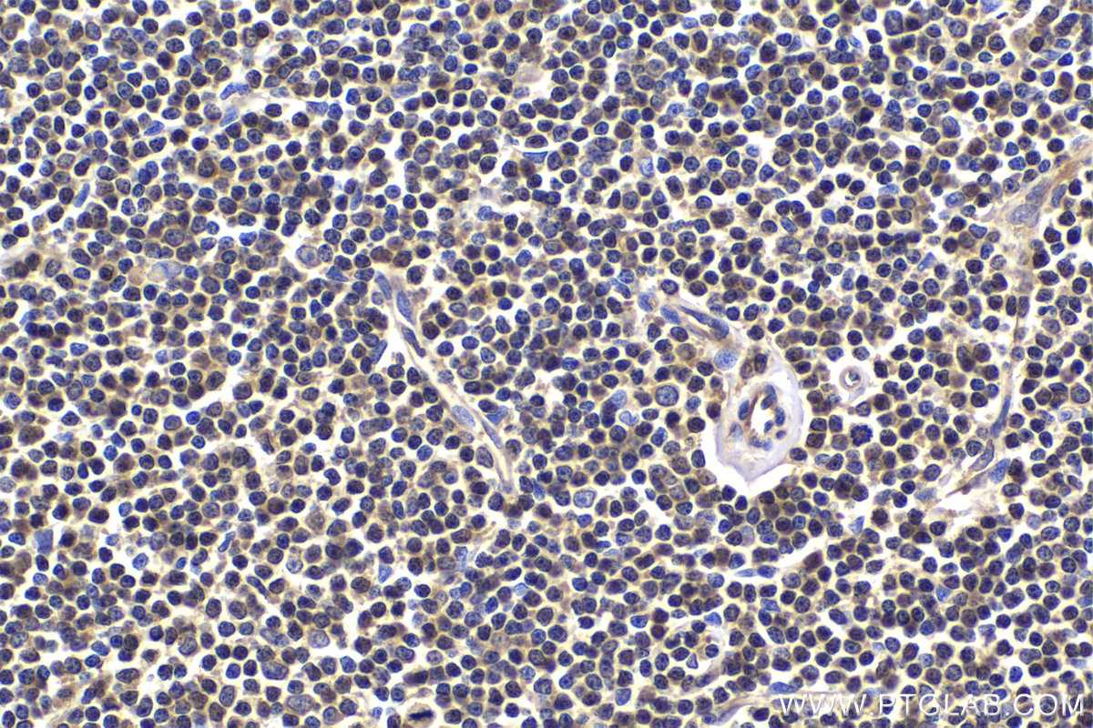 Immunohistochemical analysis of paraffin-embedded human lymphoma tissue slide using KHC2195 (PLCG2 IHC Kit).