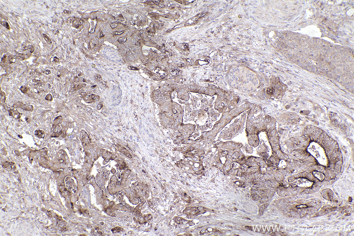 Immunohistochemical analysis of paraffin-embedded human stomach cancer tissue slide using KHC2459 (PLD1 IHC Kit).