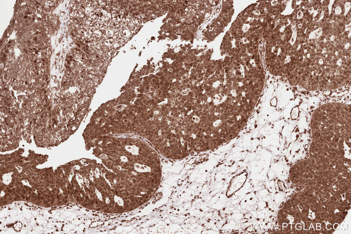 Immunohistochemical analysis of paraffin-embedded human ovary cancer tissue slide using KHC2529 (PLK5P IHC Kit).