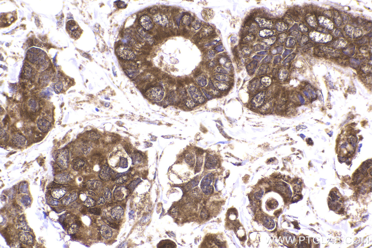 Immunohistochemical analysis of paraffin-embedded human stomach cancer tissue slide using KHC2224 (PRDX5 IHC Kit).