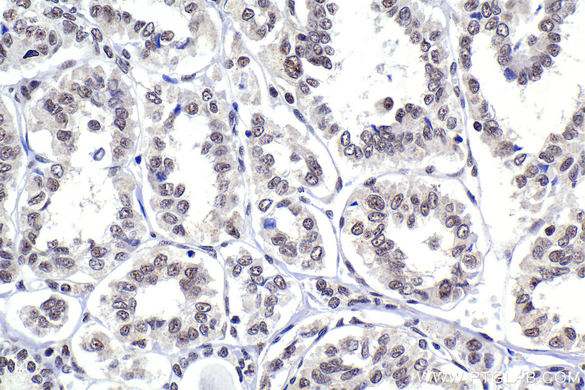 Immunohistochemical analysis of paraffin-embedded human thyroid cancer tissue slide using KHC2288 (PRIM1 IHC Kit).