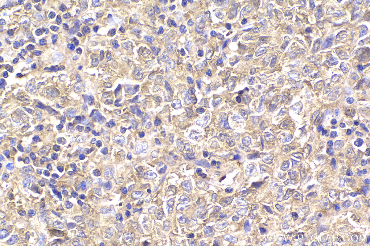 Immunohistochemical analysis of paraffin-embedded human malignant melanoma tissue slide using KHC2175 (PRKAR1A IHC Kit).