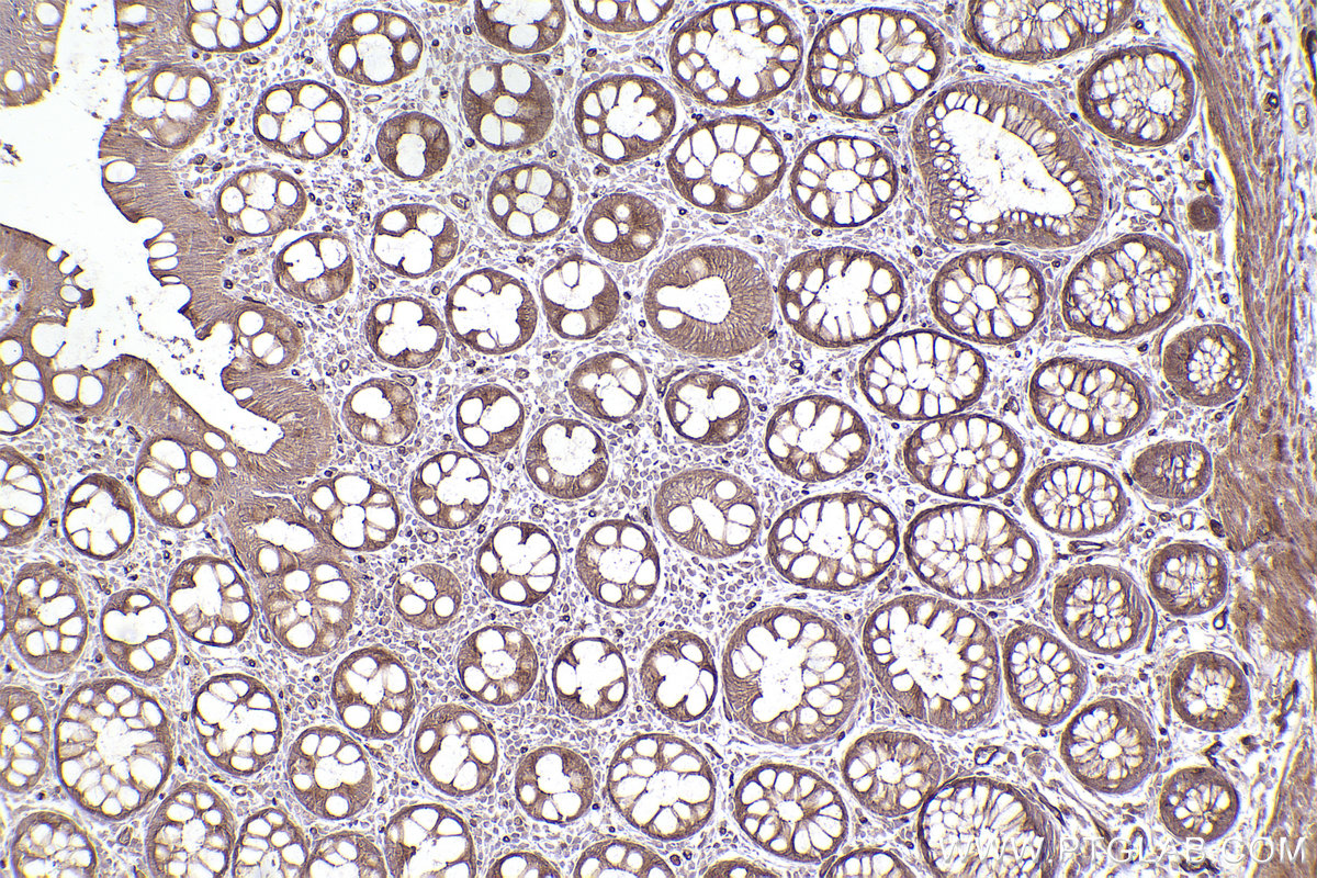 Immunohistochemical analysis of paraffin-embedded human rectal cancer tissue slide using KHC2481 (PRKD1 IHC Kit).