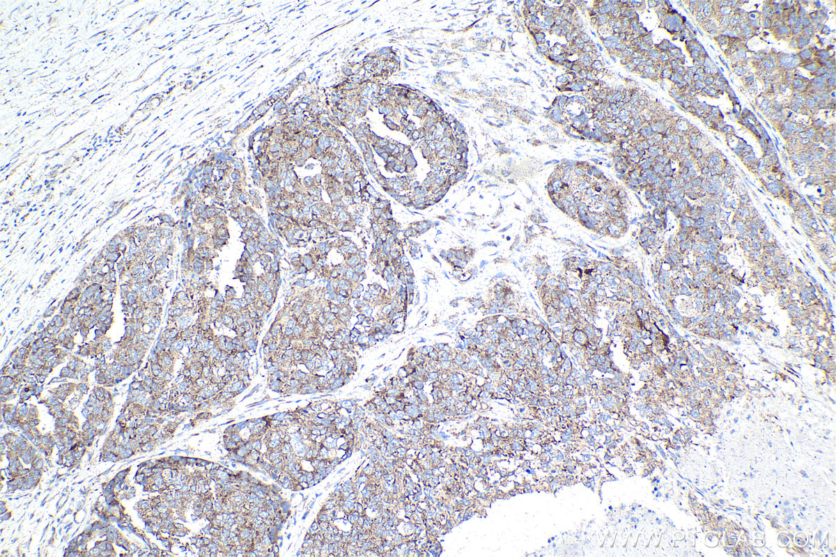 Immunohistochemical analysis of paraffin-embedded human ovary cancer tissue slide using KHC2115 (PRKRA IHC Kit).