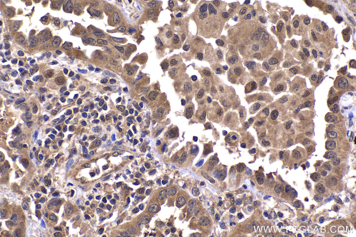 Immunohistochemical analysis of paraffin-embedded human lung cancer tissue slide using KHC2075 (PSMD3 IHC Kit).
