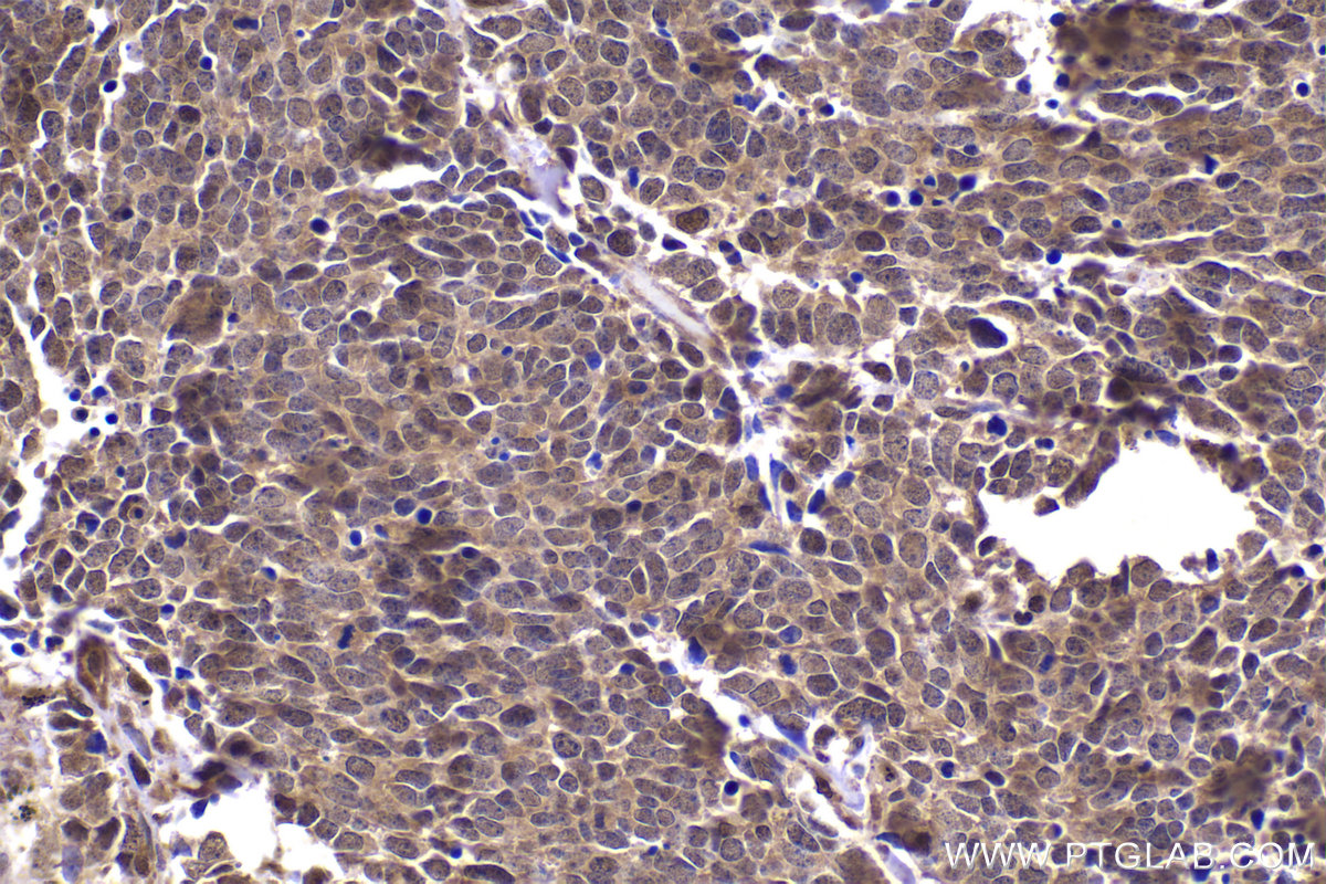 Immunohistochemical analysis of paraffin-embedded human lung cancer tissue slide using KHC2328 (PSMD4 IHC Kit).