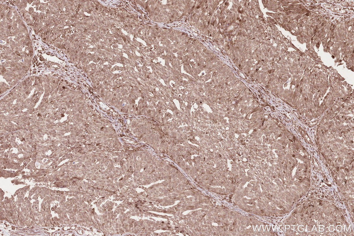 Immunohistochemical analysis of paraffin-embedded human ovary cancer tissue slide using KHC2589 (PSRC1 IHC Kit).