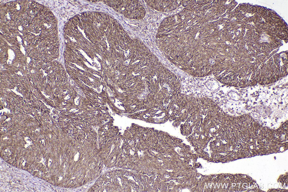 Immunohistochemical analysis of paraffin-embedded human ovary cancer tissue slide using KHC2501 (RAB11B IHC Kit).