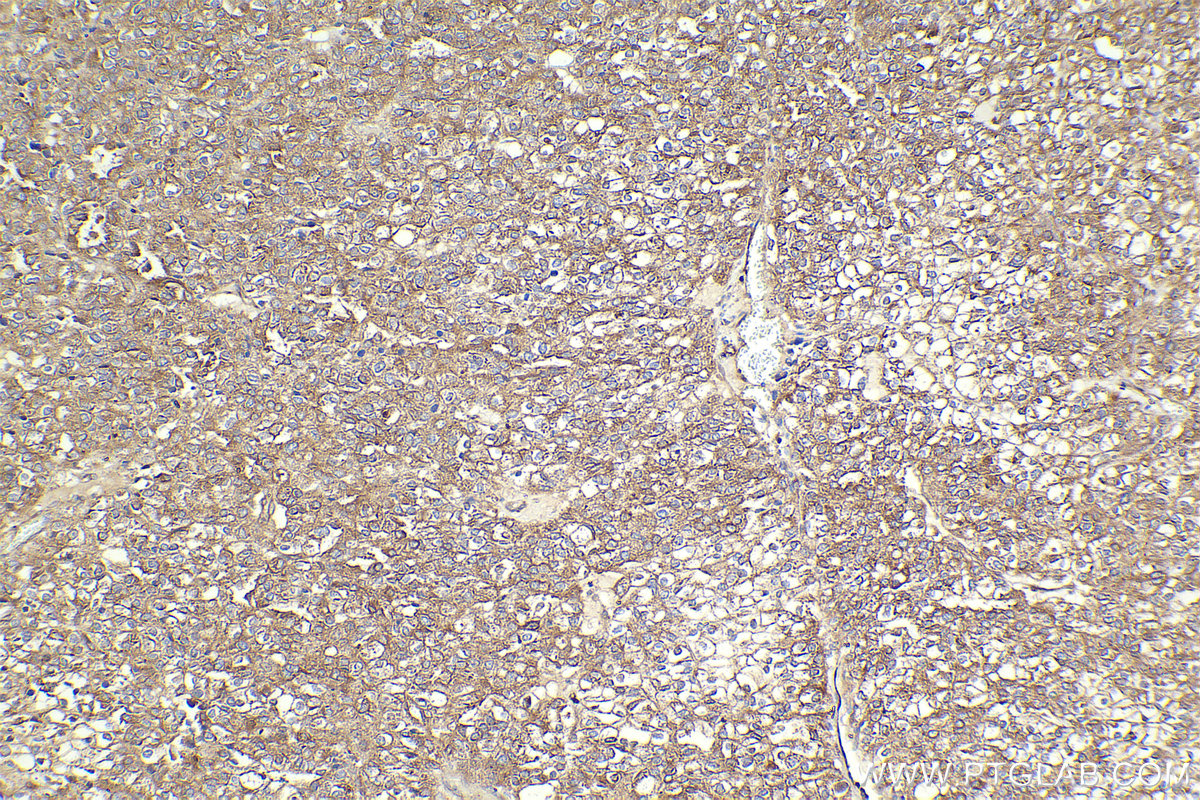 Immunohistochemical analysis of paraffin-embedded human endometrial cancer tissue slide using KHC2302 (RAB13 IHC Kit).