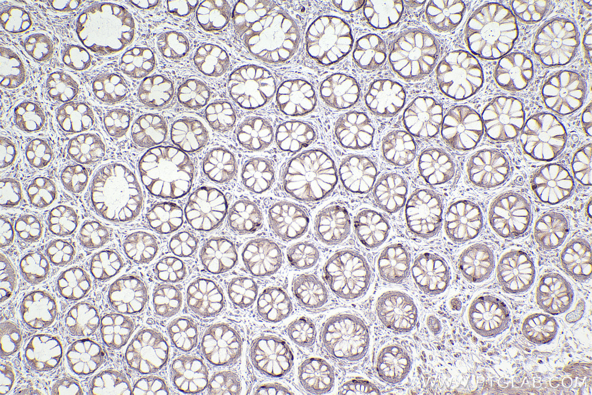 Immunohistochemical analysis of paraffin-embedded human rectal cancer tissue slide using KHC2519 (RAB30 IHC Kit).