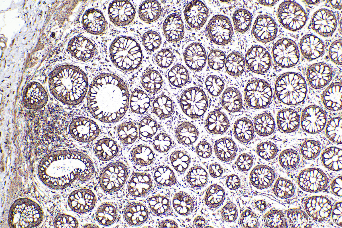 Immunohistochemical analysis of paraffin-embedded human rectal cancer tissue slide using KHC2440 (RAB31 IHC Kit).