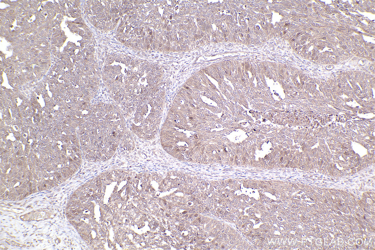 Immunohistochemical analysis of paraffin-embedded human ovary cancer tissue slide using KHC2484 (RAB35 IHC Kit).