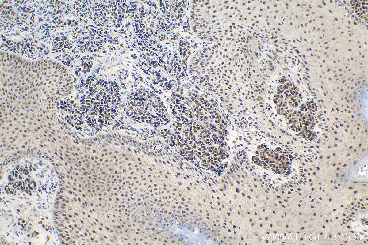 Immunohistochemical analysis of paraffin-embedded human malignant melanoma tissue slide using KHC2123 (RAD17 IHC Kit).