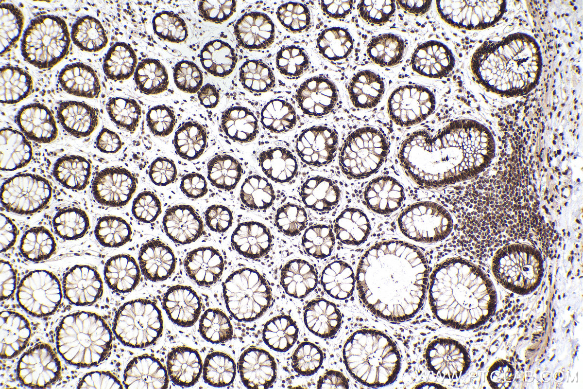 Immunohistochemical analysis of paraffin-embedded human rectal cancer tissue slide using KHC2504 (RBBP7 IHC Kit).