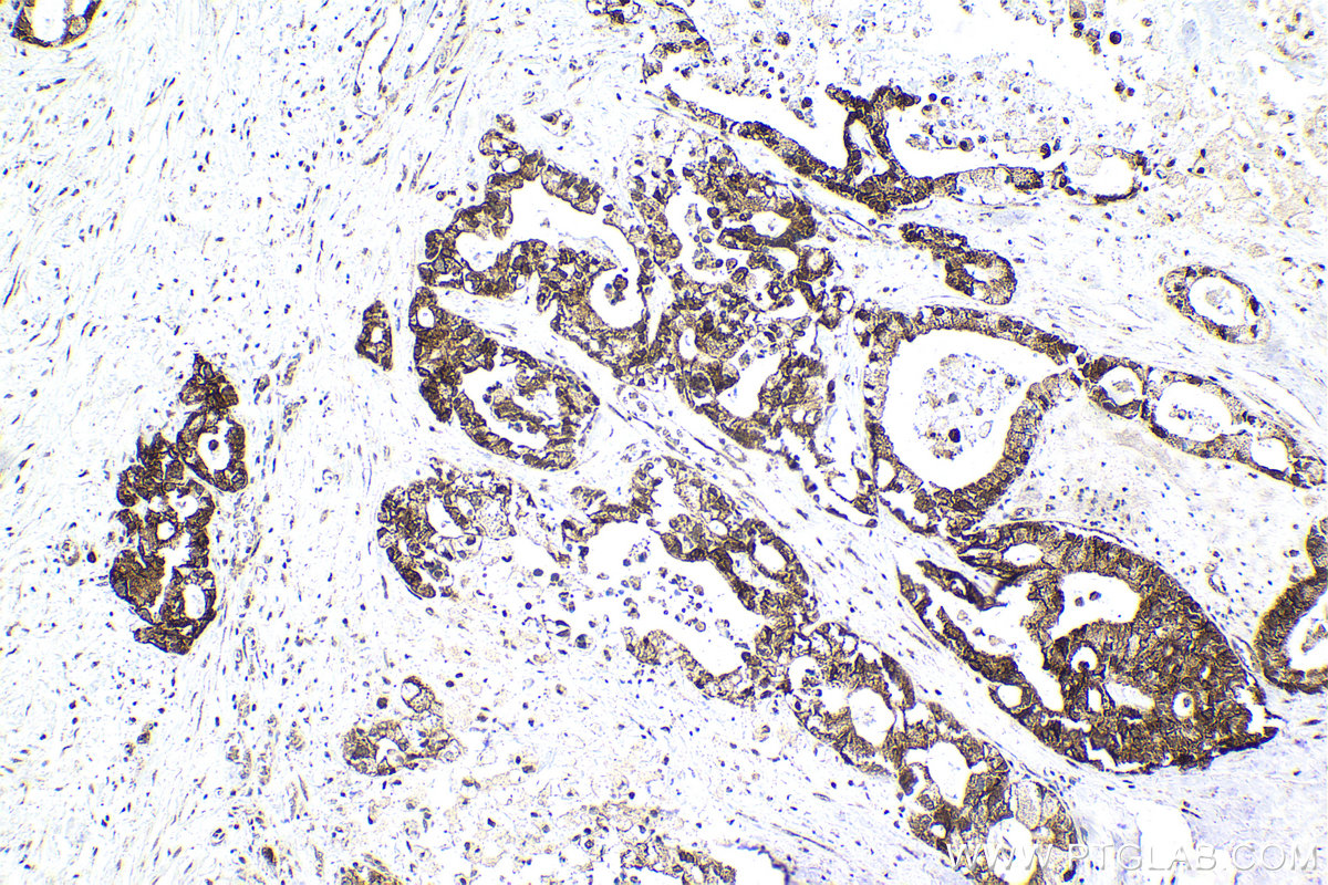 Immunohistochemical analysis of paraffin-embedded human pancreas cancer tissue slide using KHC2127 (RECQL4 IHC Kit).