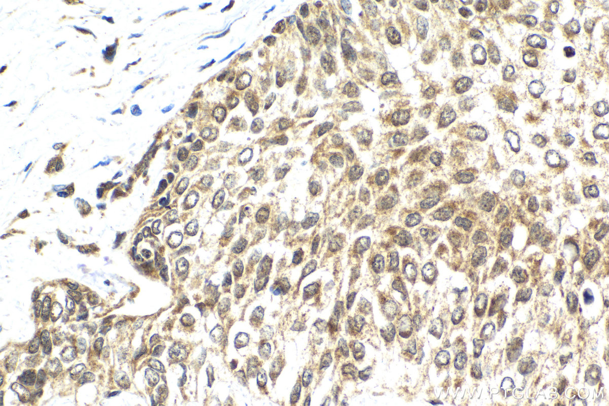 Immunohistochemical analysis of paraffin-embedded human urothelial carcinoma tissue slide using KHC2128 (RECQL5 IHC Kit).