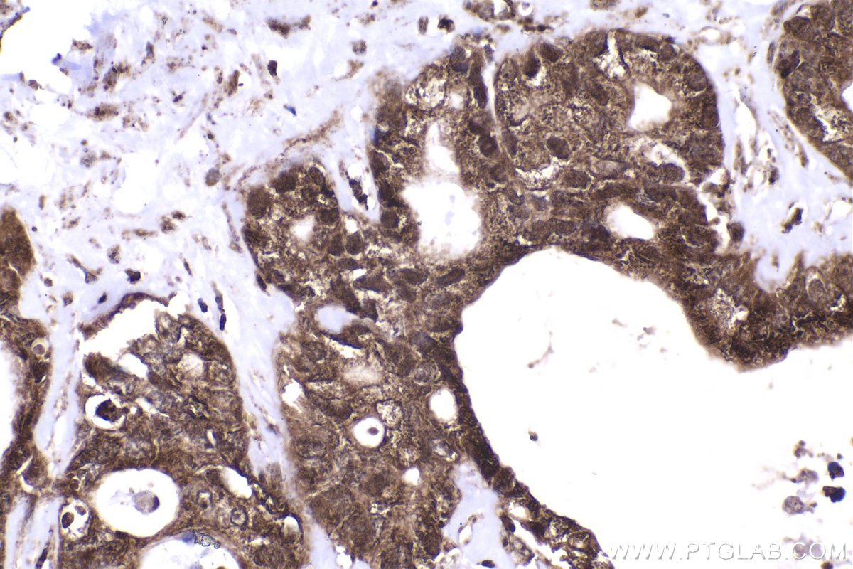 Immunohistochemical analysis of paraffin-embedded human pancreas cancer tissue slide using KHC2258 (RGS2 IHC Kit).