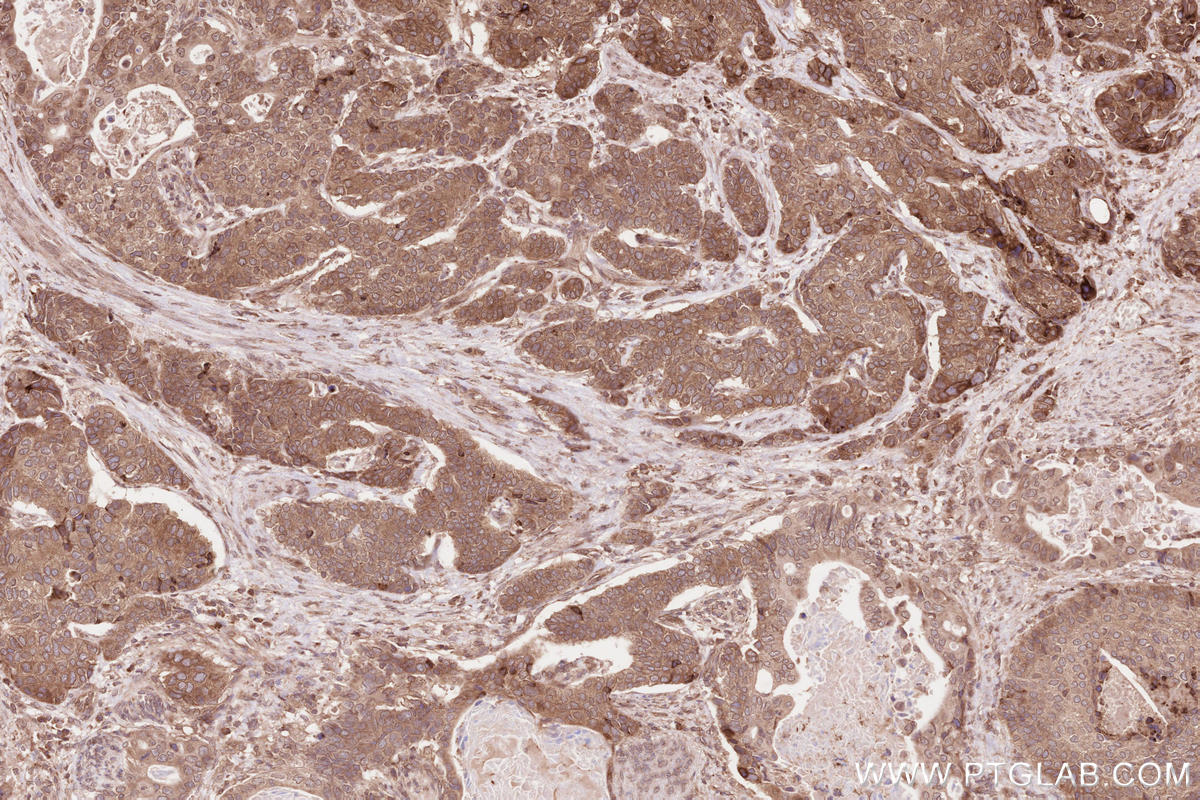 Immunohistochemical analysis of paraffin-embedded human stomach cancer tissue slide using KHC2594 (RICTOR IHC Kit).