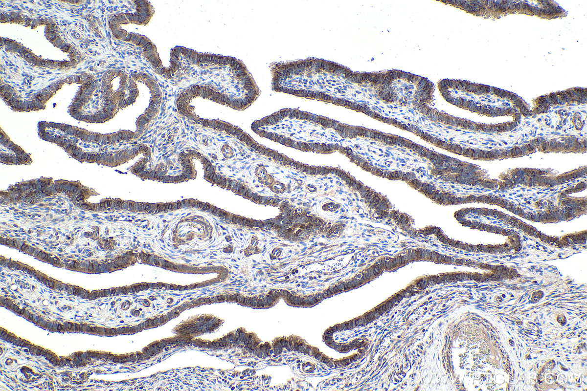 Immunohistochemical analysis of paraffin-embedded human ovary tumor tissue slide using KHC1938 (RMND5A IHC Kit).