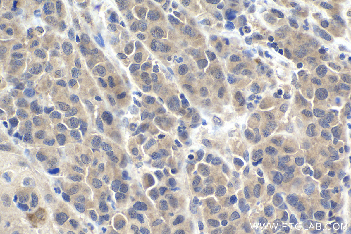 Immunohistochemical analysis of paraffin-embedded human malignant melanoma tissue slide using KHC1938 (RMND5A IHC Kit).