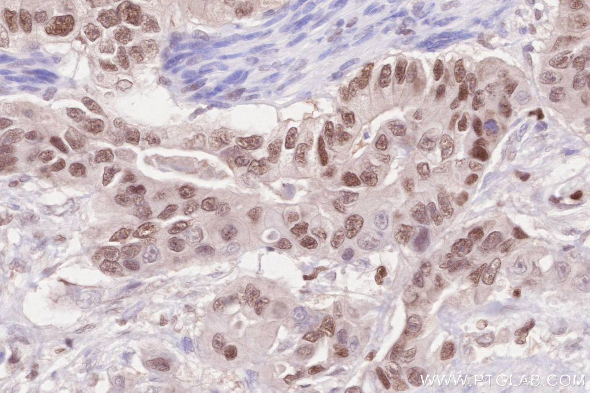 Immunohistochemical analysis of paraffin-embedded human stomach cancer tissue slide using KHC2557 (RNASEH2B IHC Kit).